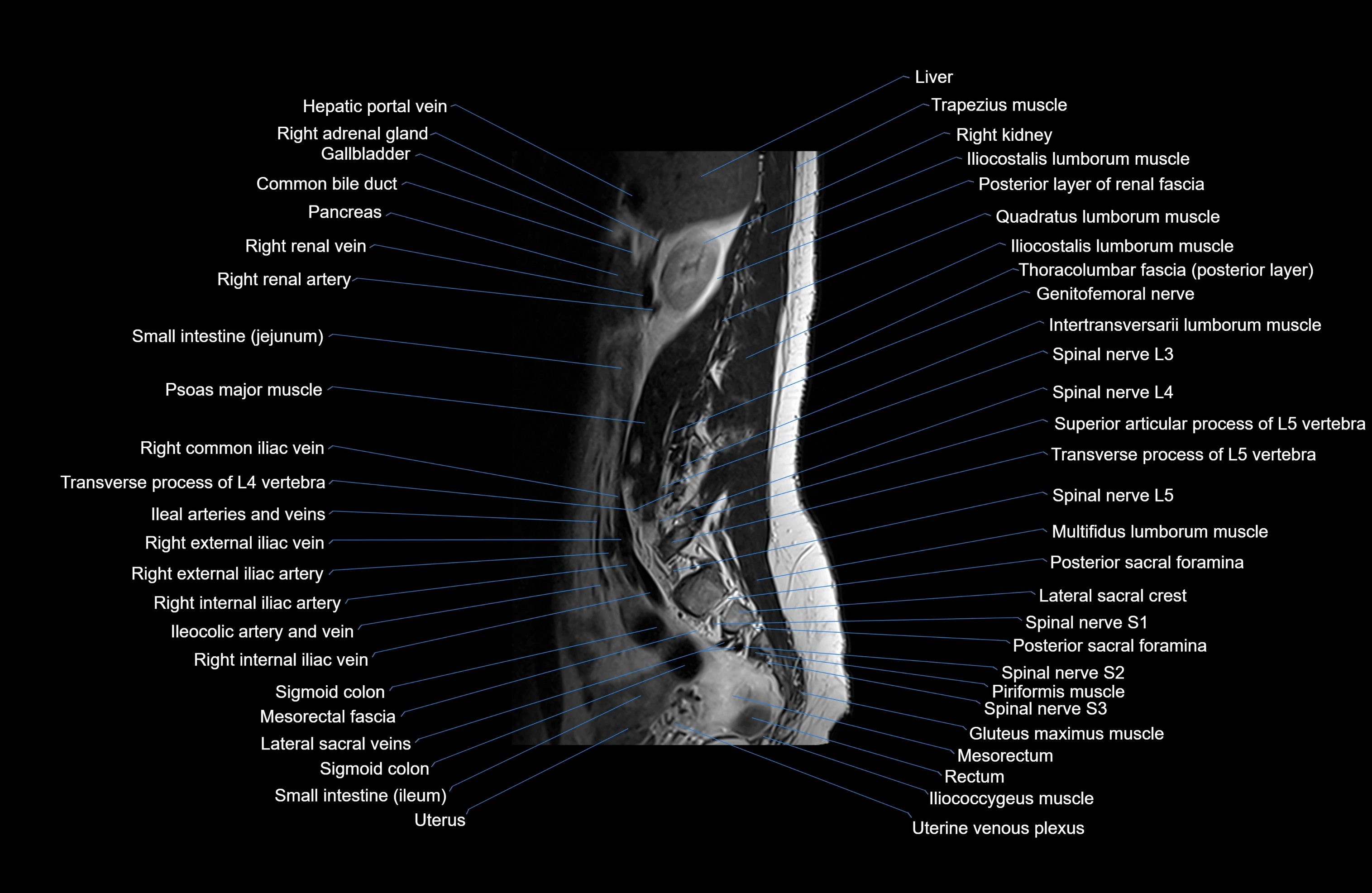 MRI lumbar spine sagittal cross sectional anatomy 3T radiology  image-img-00001-00003.webp